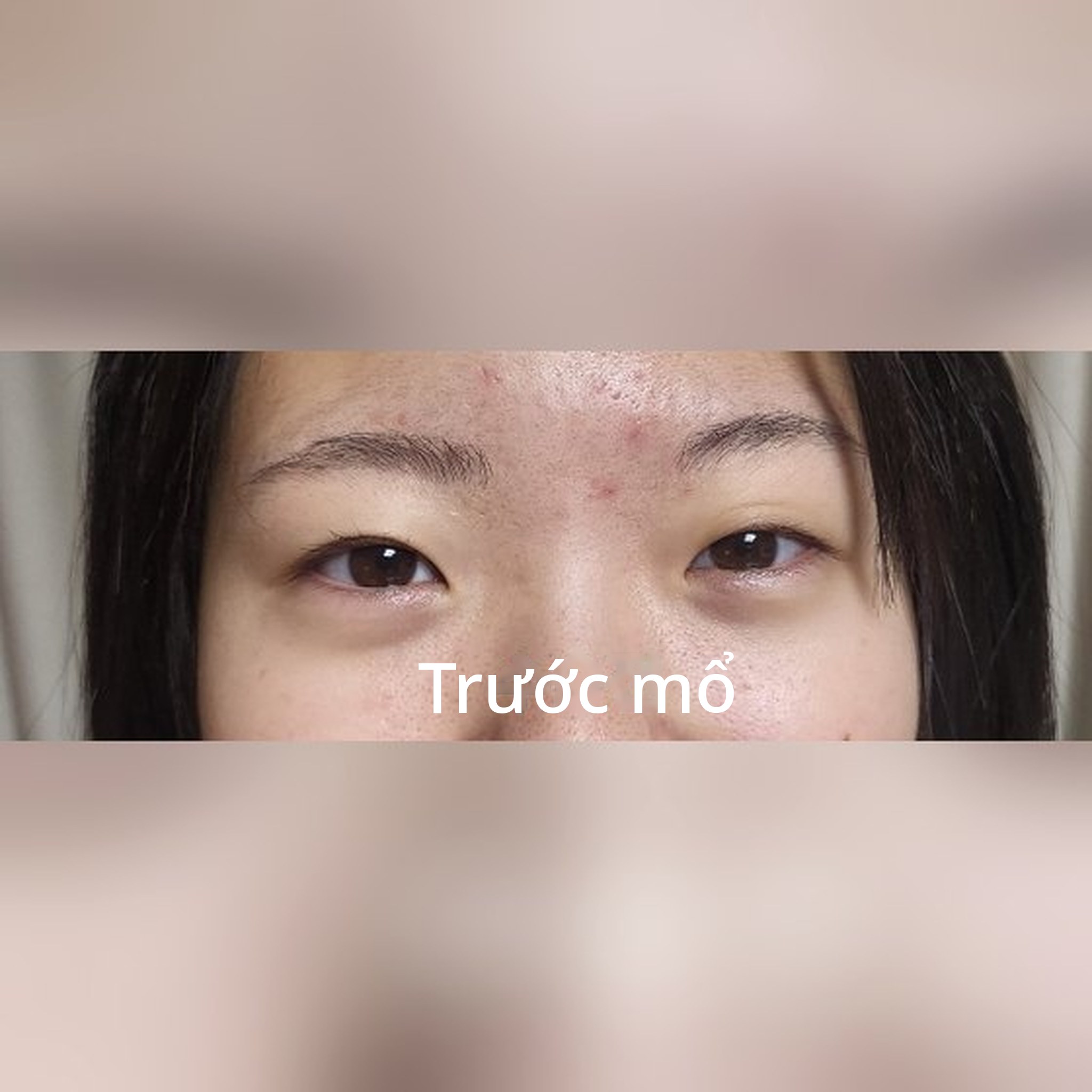 Ảnh thu nhỏ bài review phẫu thuật mắt — Mình xin chia sẻ review cắt mí đôi của con gái đang học cấp ba~~