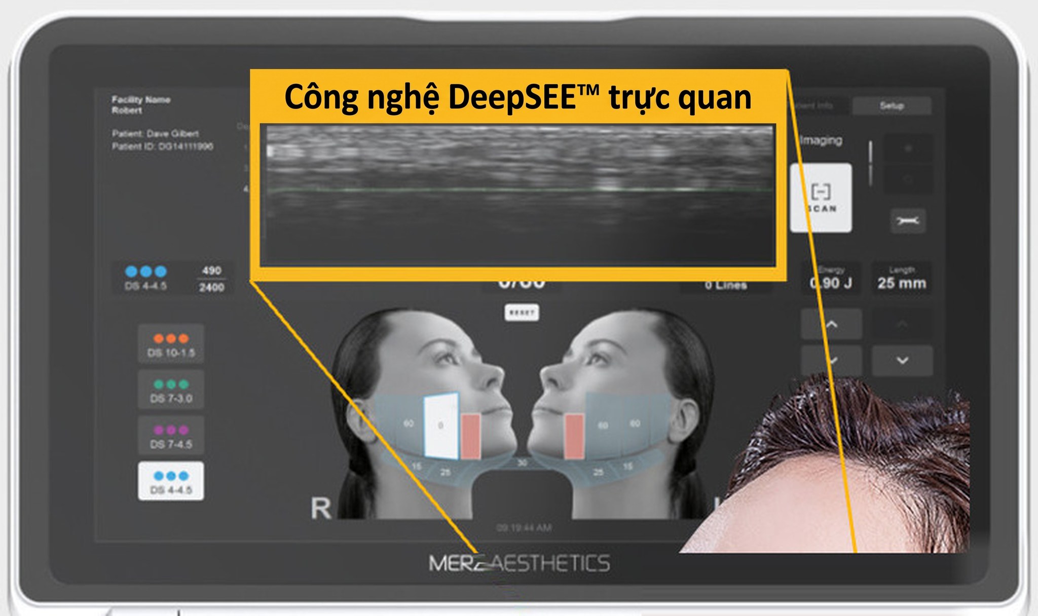 Màn hình Ultherapy PRIME — màn hình thiết bị nhìn rõ viền bezel bốn cạnh