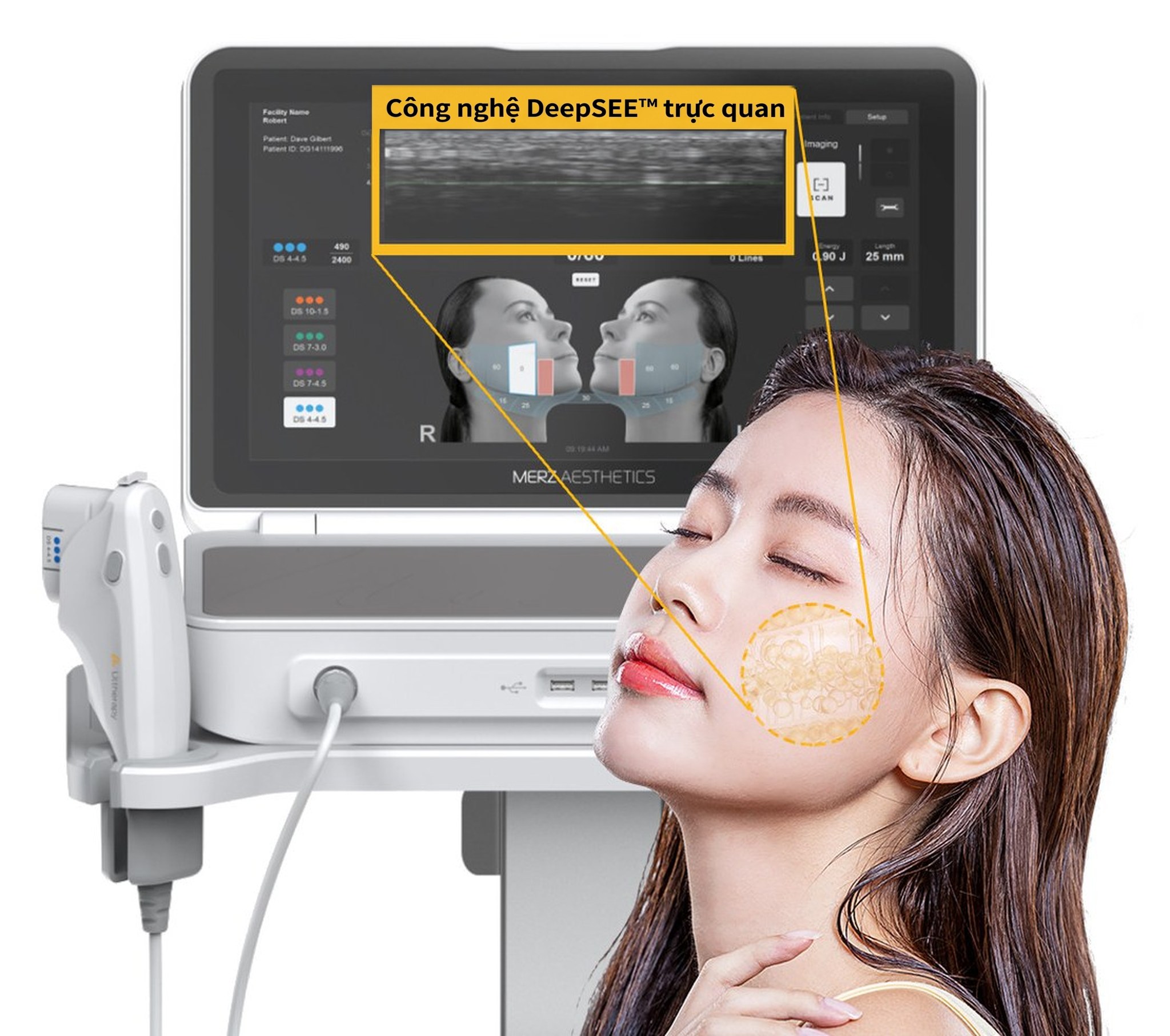 Vùng quan sát siêu âm được đánh dấu trên má người mẫu nữ nhắm mắt, ngửa đầu ra sau — mô bên trong da được phóng to hiển thị