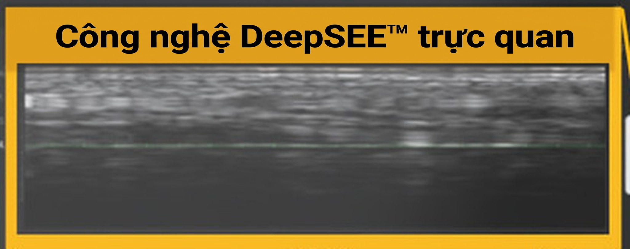 Chú thích DeepSEE trên màn hình Ultherapy PRIME — lát cắt siêu âm bên trong da theo thời gian thực