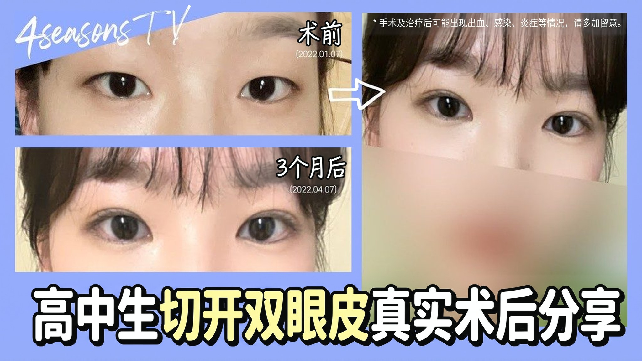 4seasonsTV 视频缩略图 - 高中生切开双眼皮真实术后分享,术前(2022.01.07)与术后3个月(2022.04.07)眼睛对比