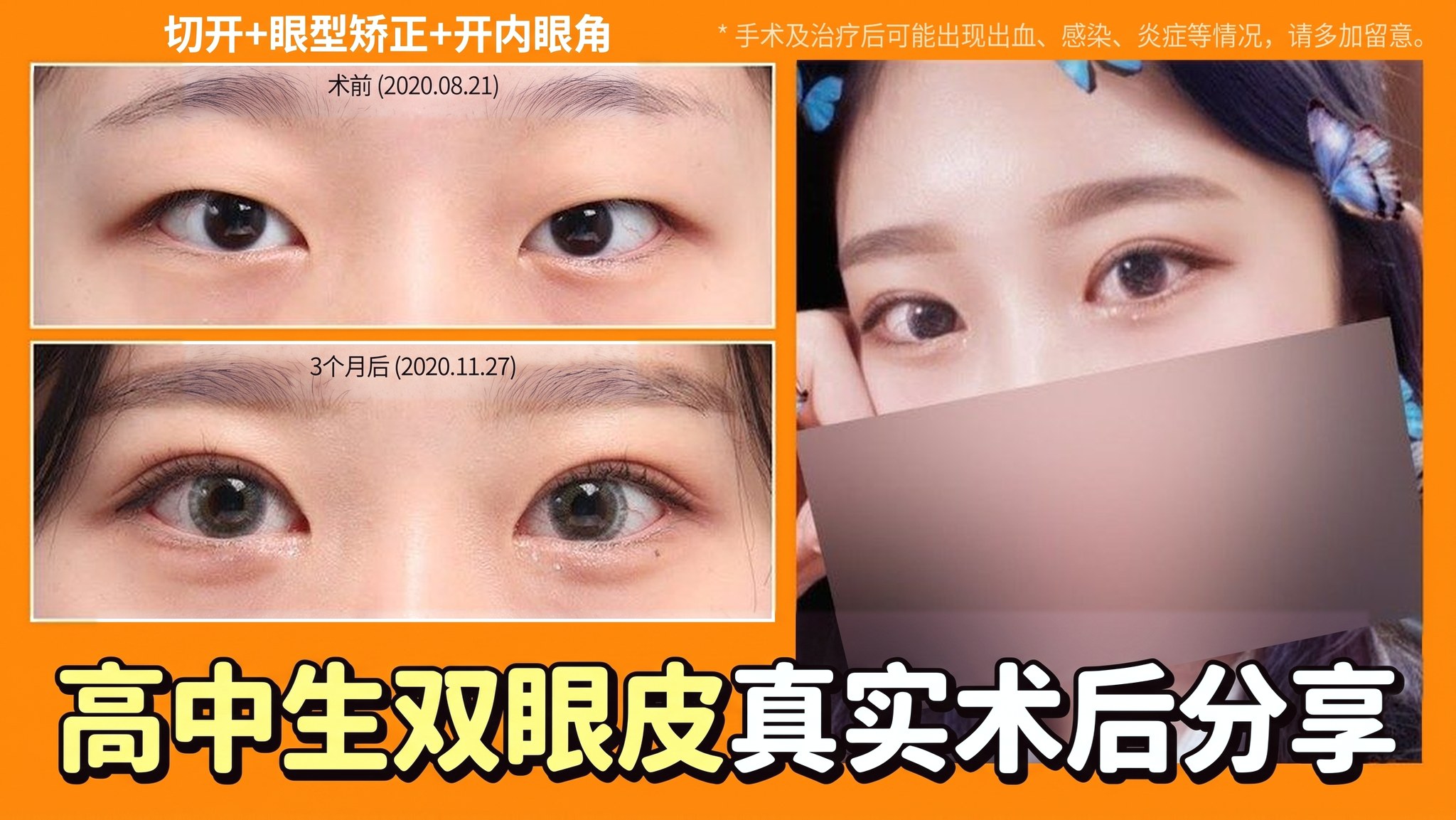 4seasonsTV 视频缩略图 - 高中生双眼皮真实术后分享,切开+眼型矫正+开内眼角,术前(2020.08.21)与术后3个月(2020.11.27)眼睛对比