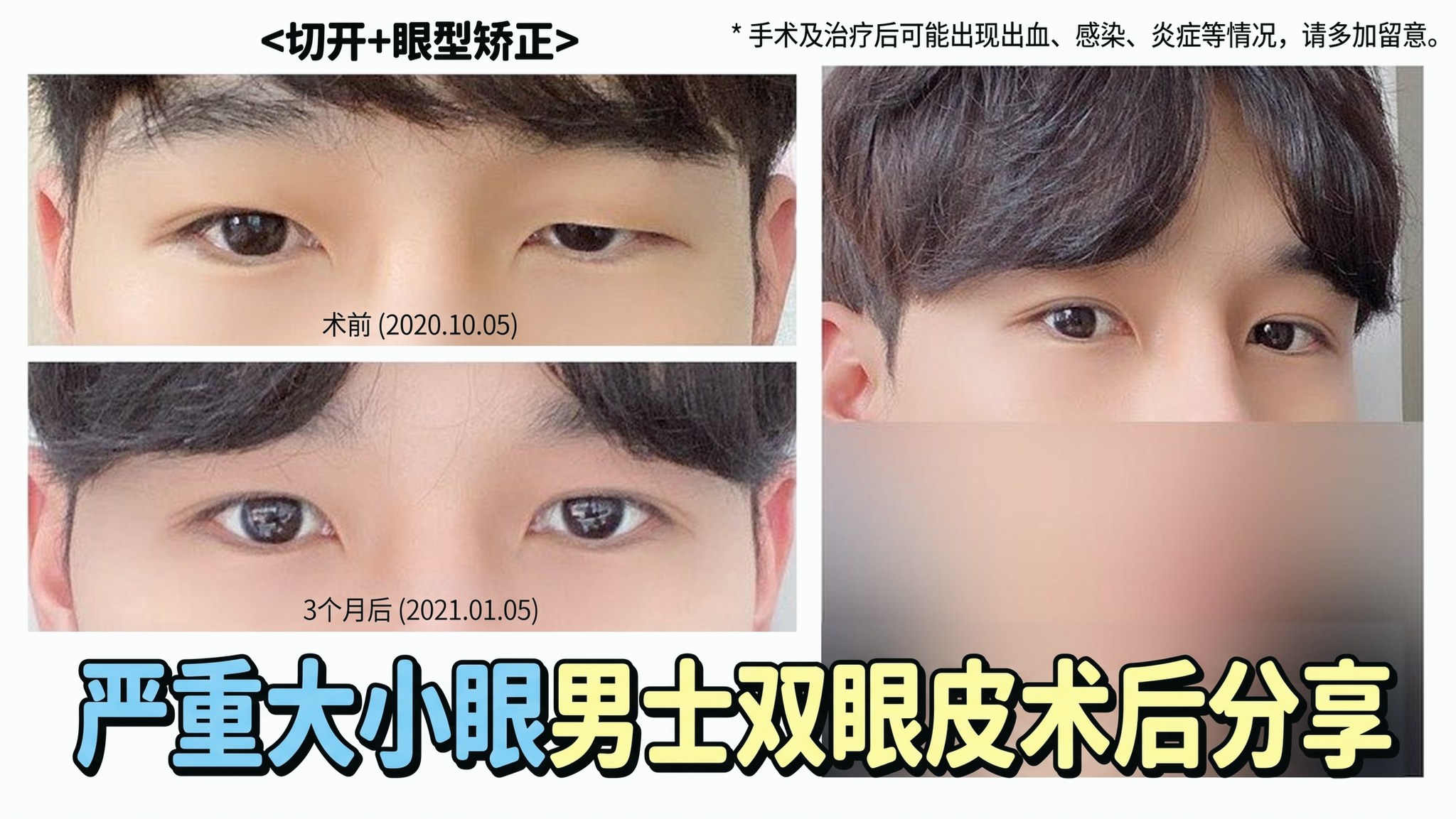4seasonsTV 视频缩略图 - 严重大小眼男士双眼皮术后分享,切开+眼型矫正,术前(2020.10.05)与术后3个月(2021.01.05)眼睛对比