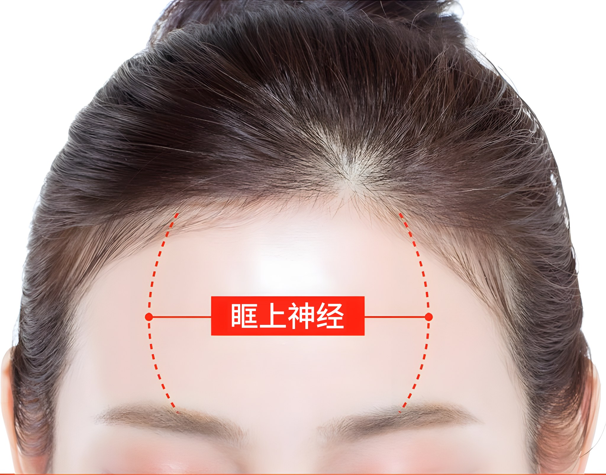 在额头照片上用红色虚线和标签标示眶上神经经过范围的示意图