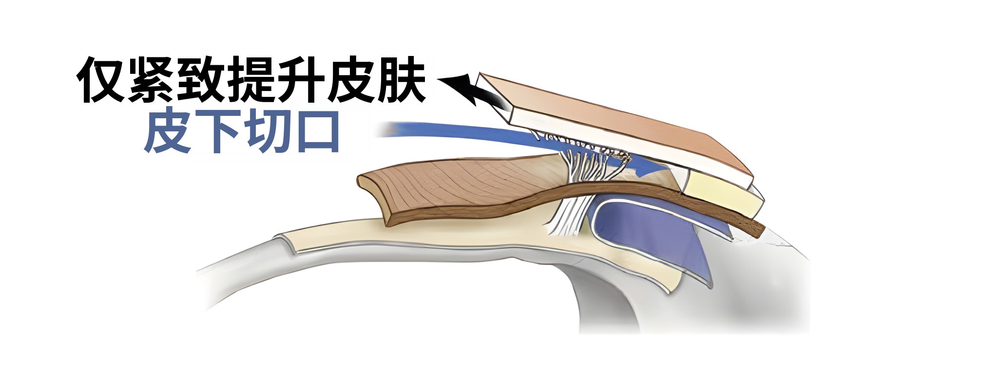 仅提升皮肤时的剖面示意图——箭头标注“仅提升皮肤”，蓝色箭头标注“皮下切口”