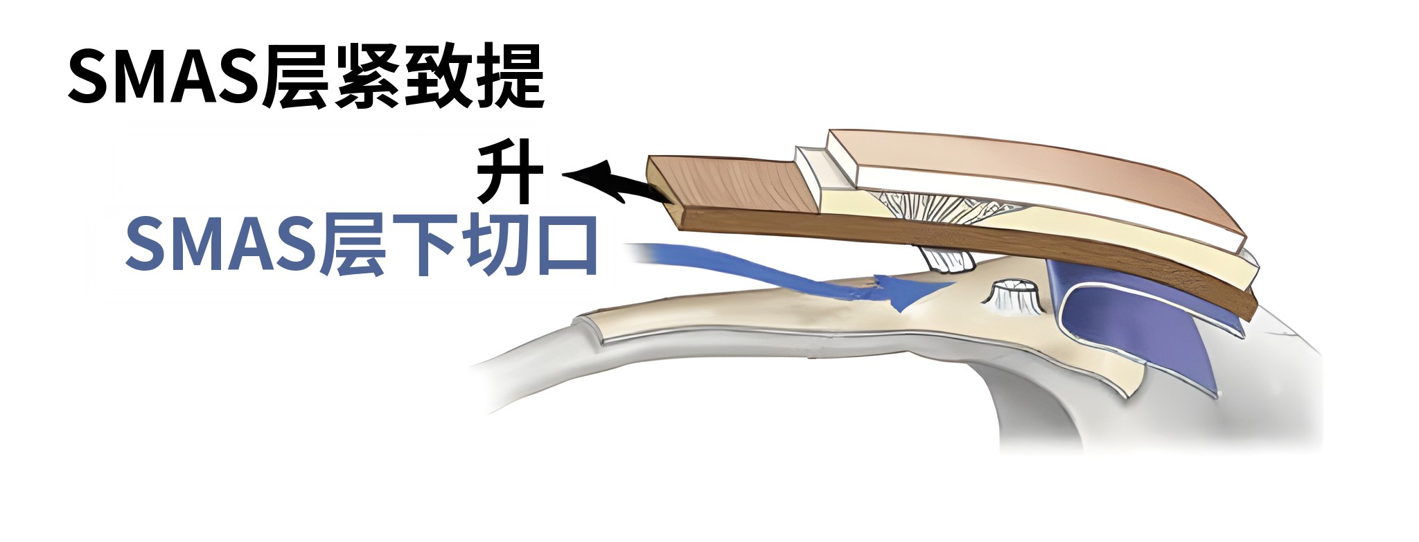 提升至SMAS层时的剖面示意图——箭头标注“SMAS层提升”，蓝色箭头标注“SMAS层下切口”