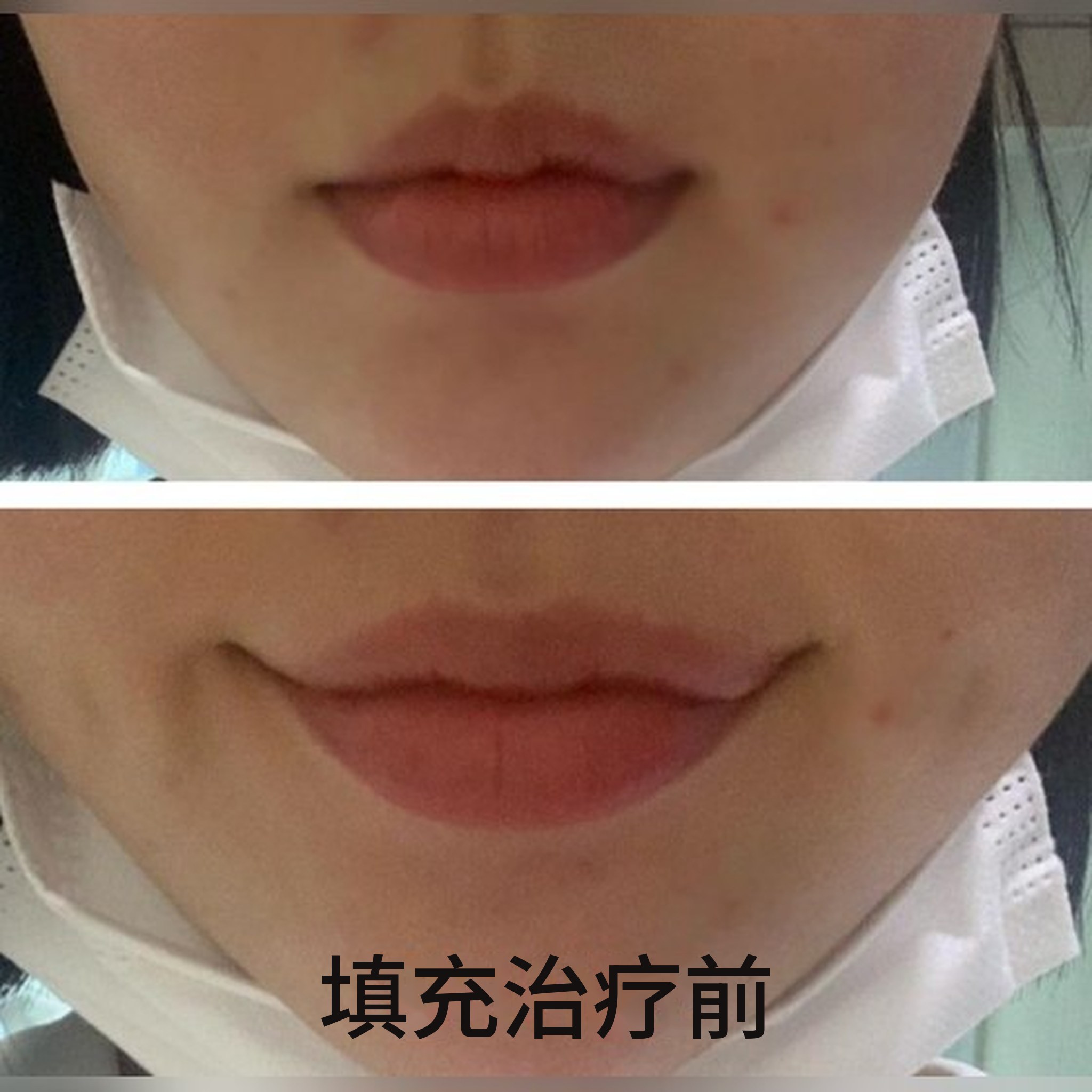 微整形术后分享帖缩略图 — 终于明白唇部填充为什么这么有名了