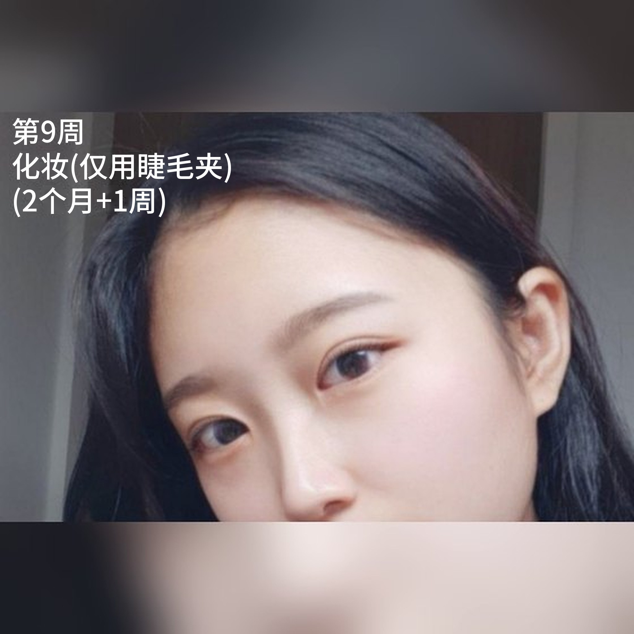 眼部整形术后分享帖缩略图 — 内双/开内眼角/眼型矫正分享