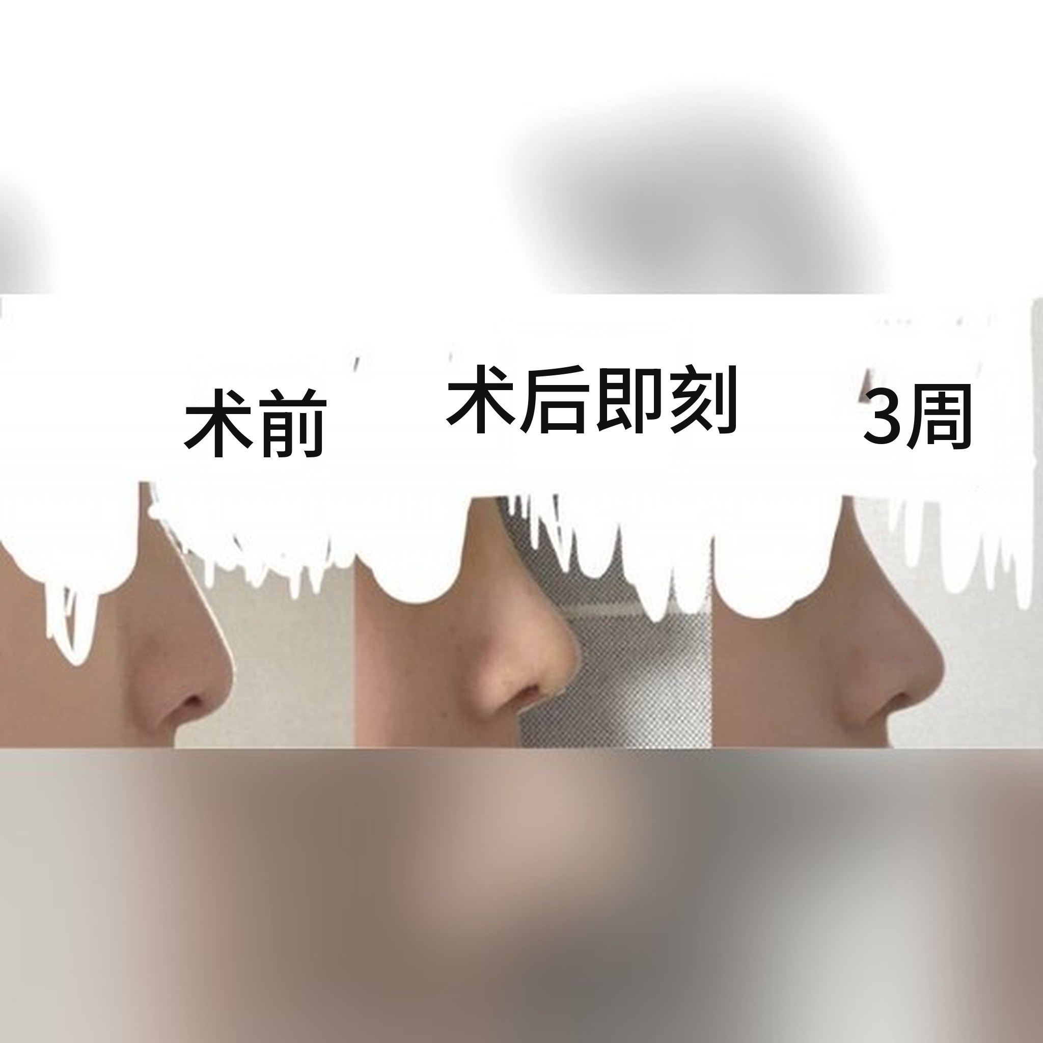 鼻部整形术后分享帖缩略图 — 推荐找Jegal Jeong⁠-⁠jae院长做鼻整形！！！^-^