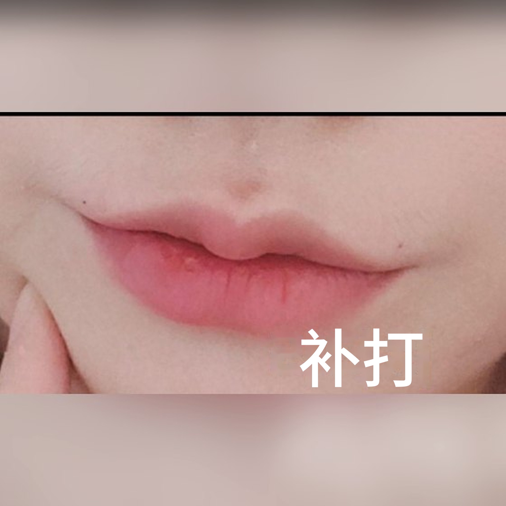 微整形术后评价帖缩略图 — 感觉是唇部填充的宝藏诊所!!哈哈