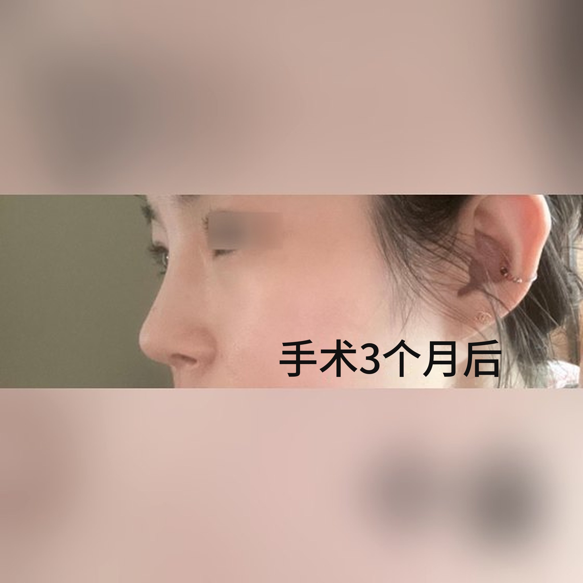 鼻整形术后评价帖缩略图 — 鼻整形第3个月,非常满意哈哈
