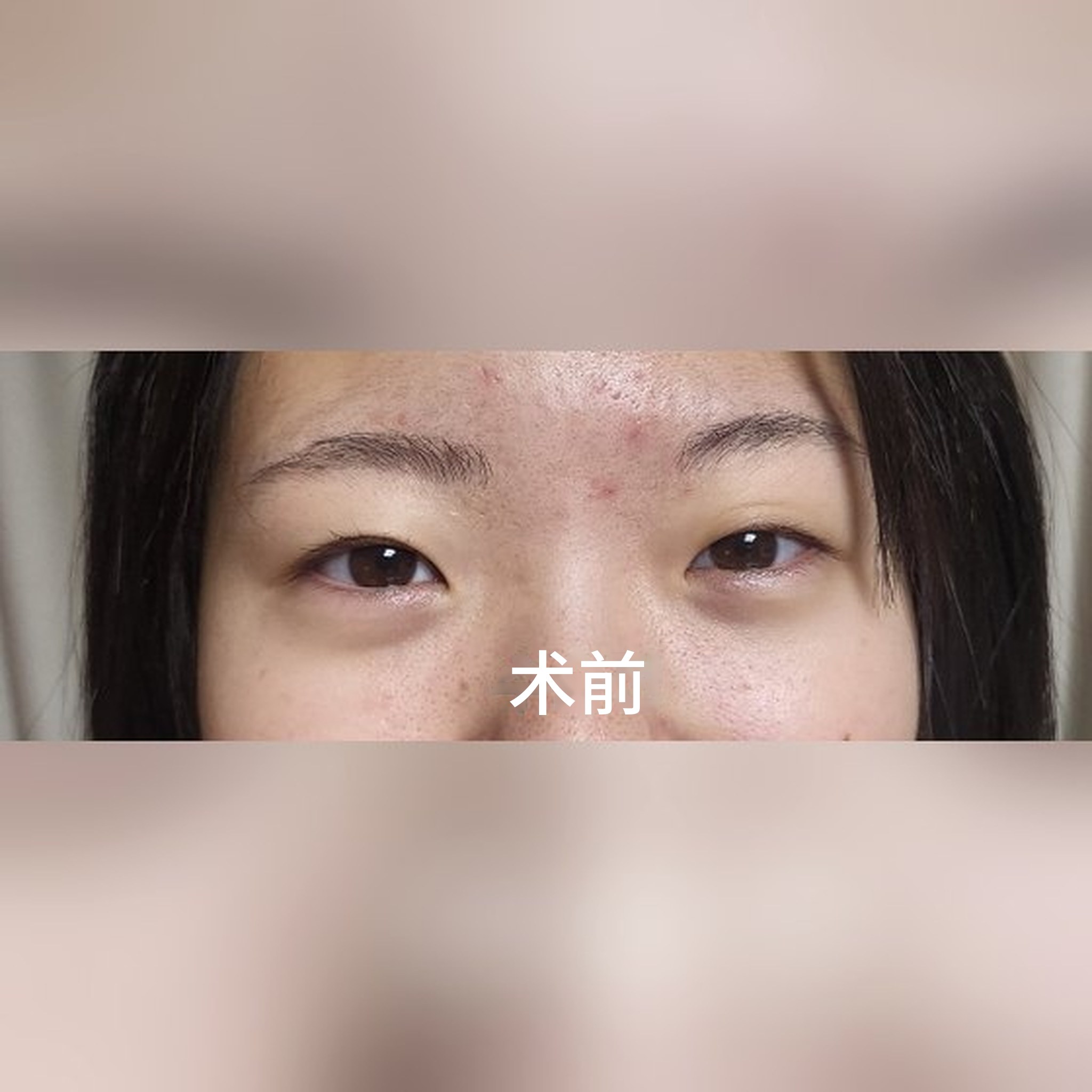 眼部整形评价帖缩略图 — 分享高中生女儿的双眼皮手术评价~~