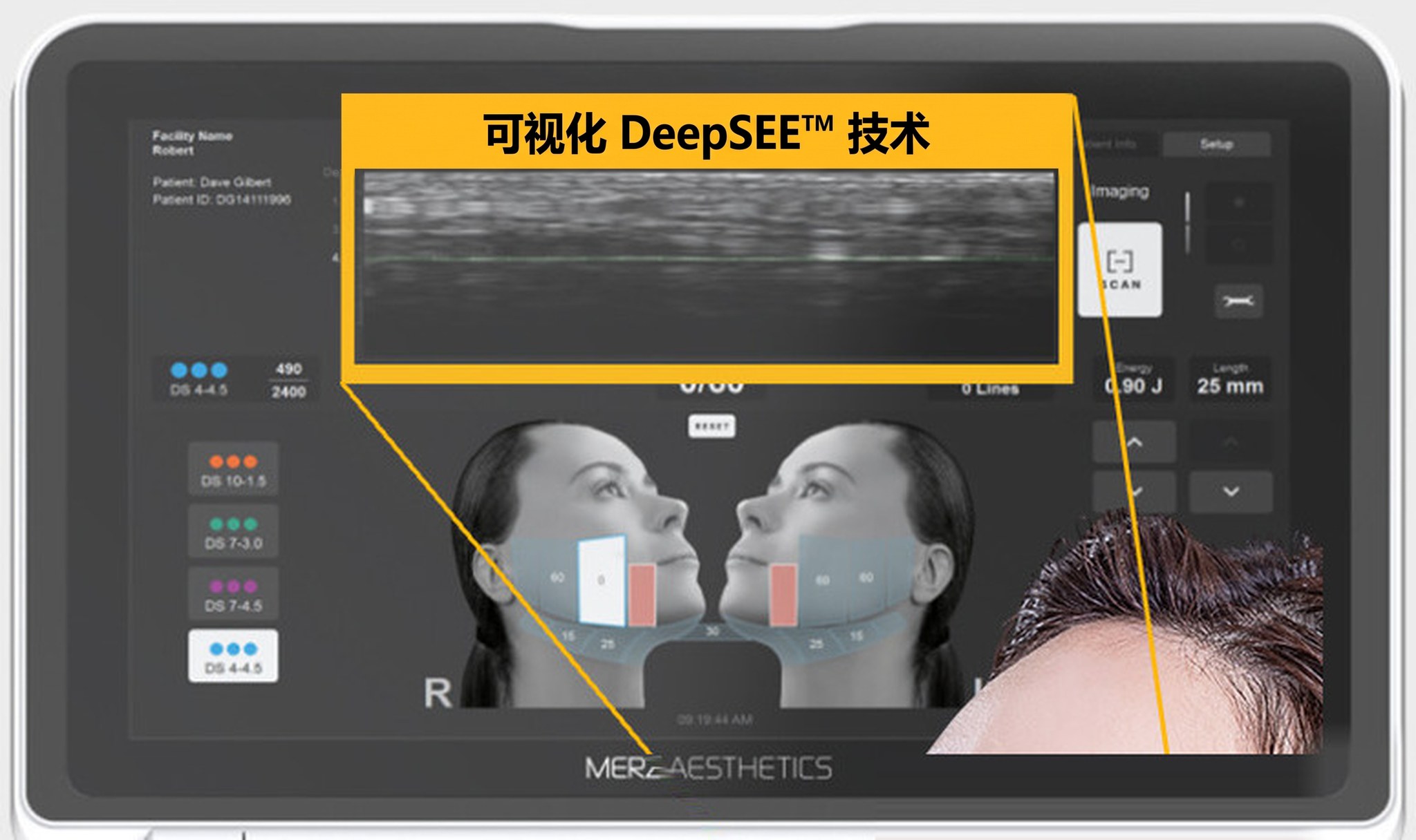 Ultherapy PRIME显示器——可见四边边框的设备屏幕