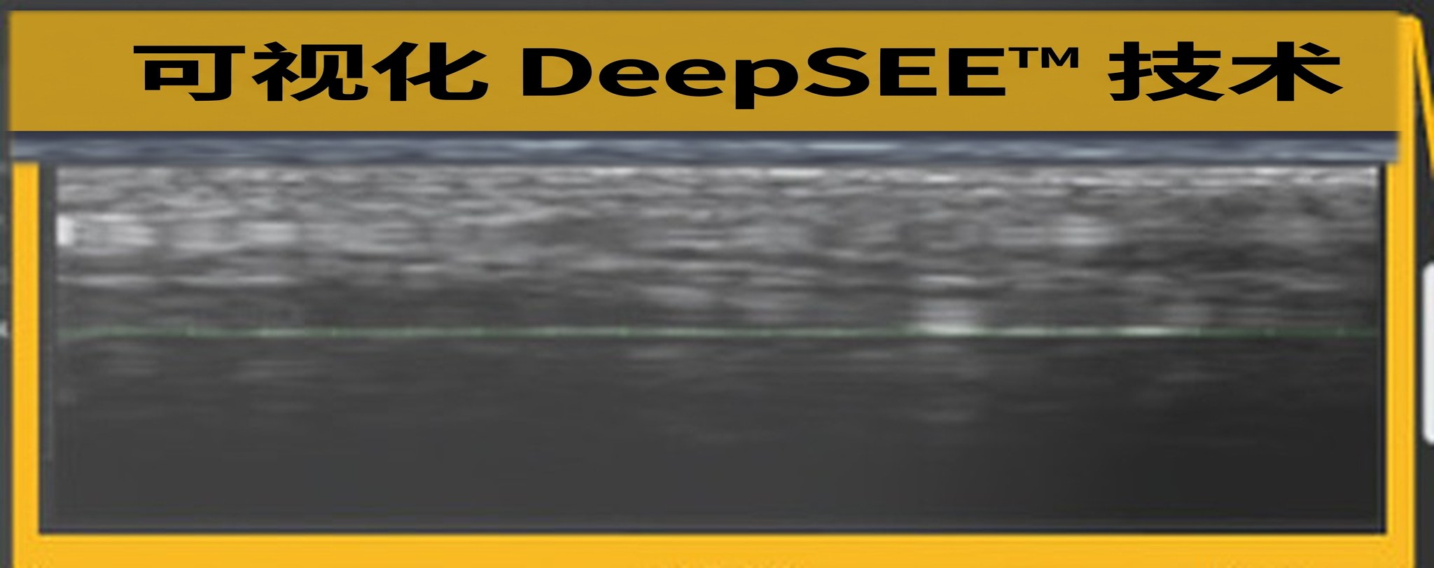 Ultherapy PRIME屏幕上的DeepSEE标注——实时皮肤内部超声截面