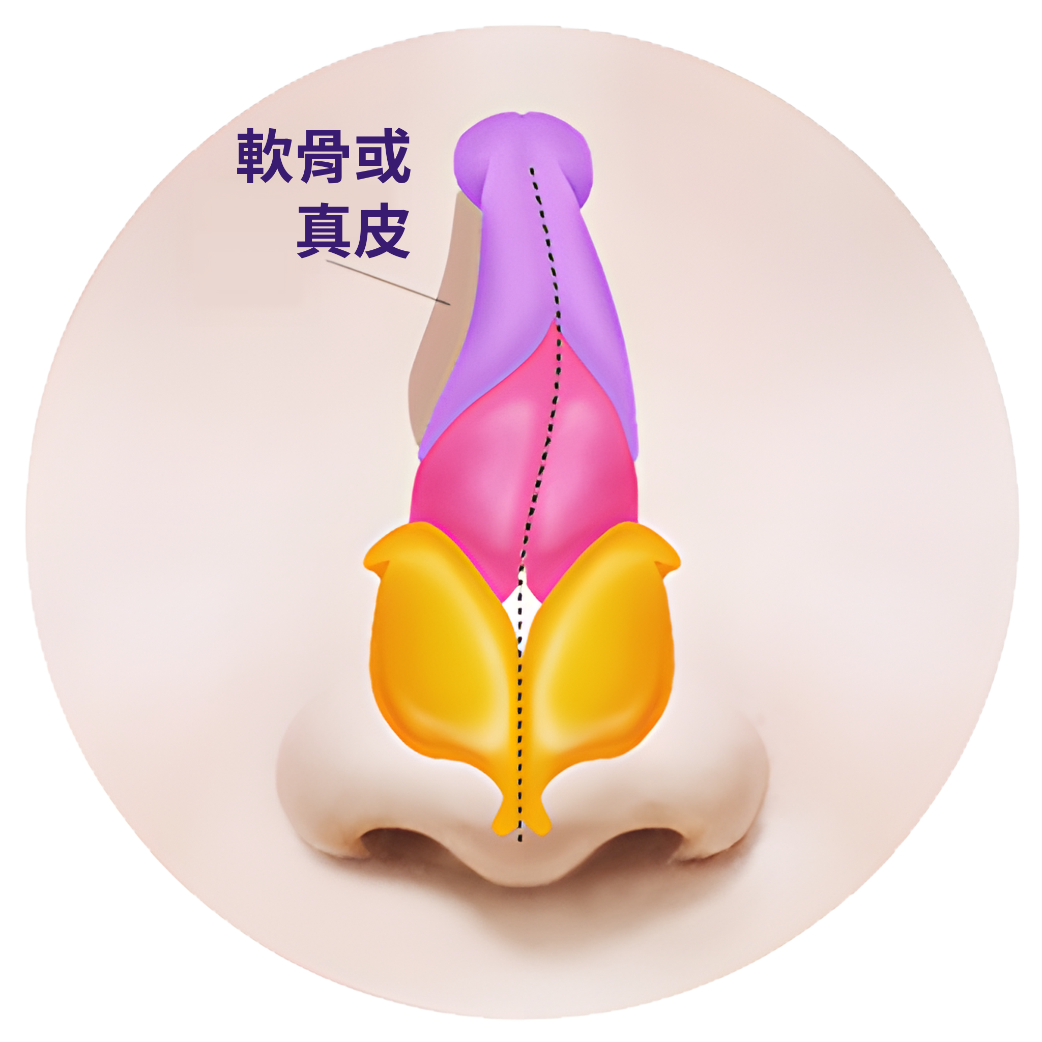 在凹陷部位移植軟骨或真皮填補後的鼻子正面剖面插圖