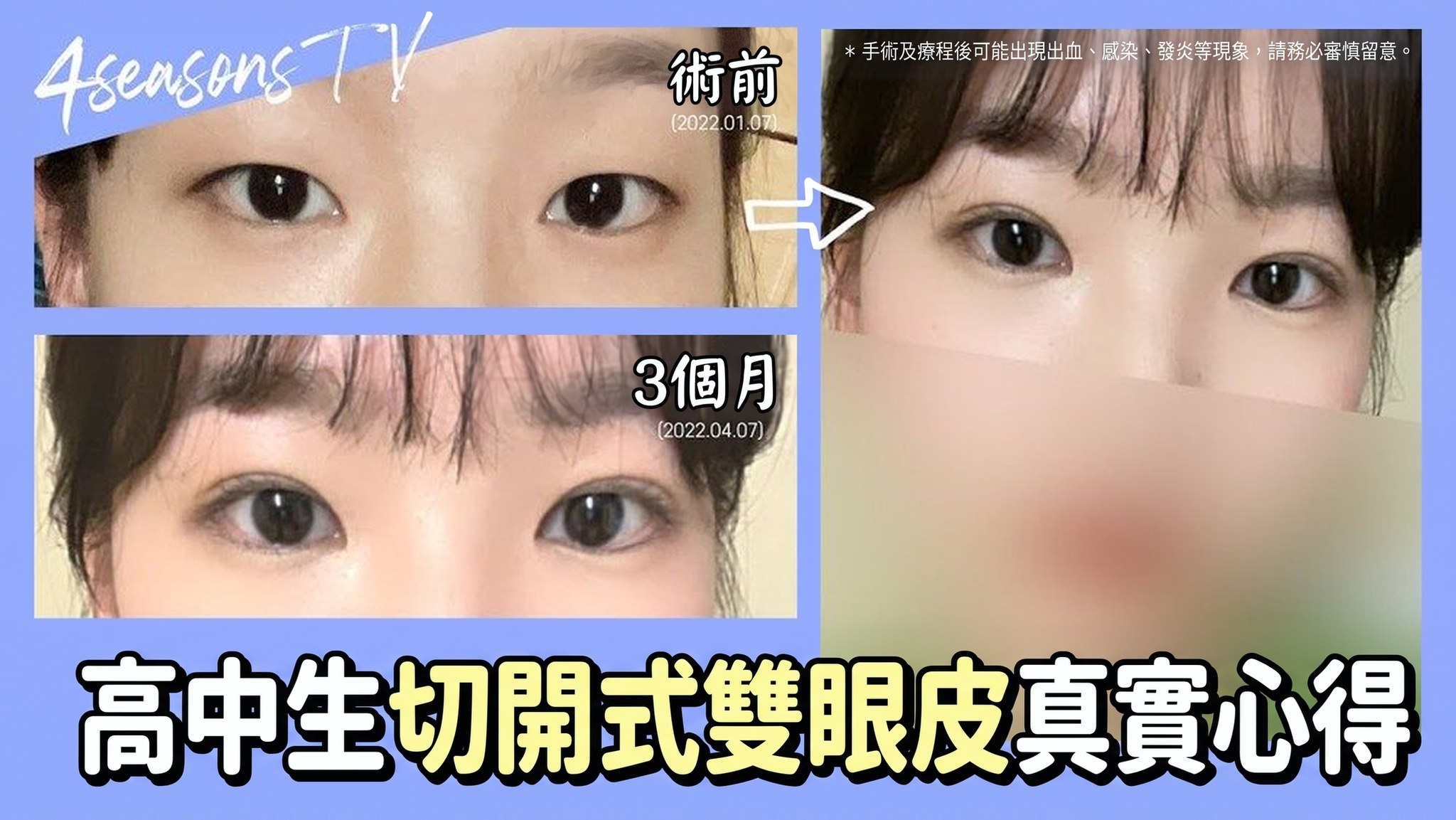 4seasonsTV 影片縮圖 - 高中生切開式雙眼皮真實心得,術前(2022.01.07)與術後3個月(2022.04.07)眼睛對比