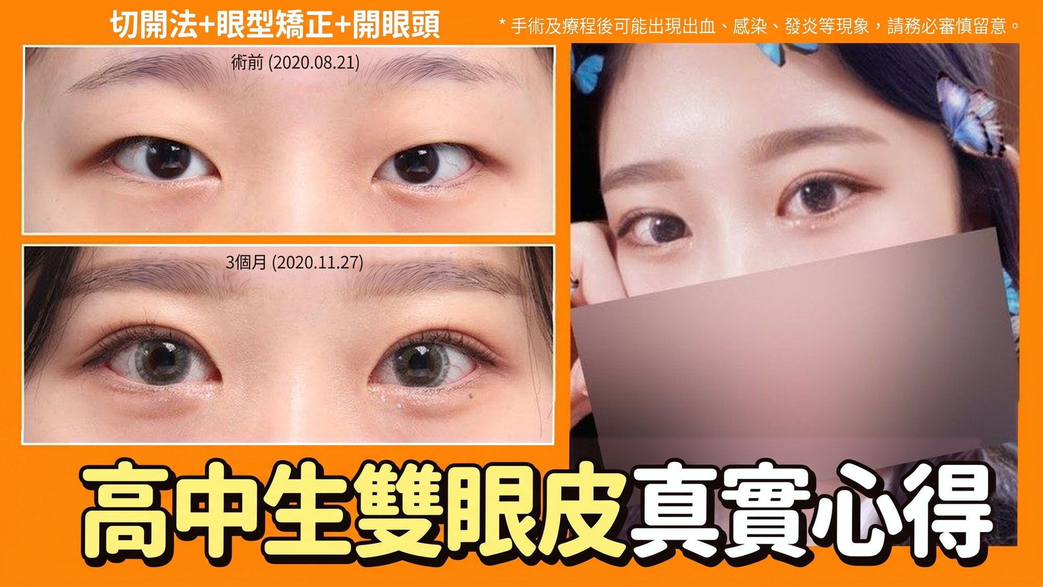 4seasonsTV 影片縮圖 - 高中生雙眼皮真實心得,切開+眼型矯正+開眼頭,術前(2020.08.21)與術後3個月(2020.11.27)眼睛對比