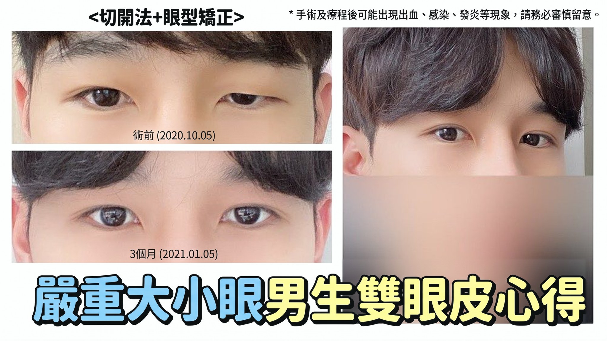 4seasonsTV 影片縮圖 - 嚴重大小眼男生雙眼皮心得,切開+眼型矯正,術前(2020.10.05)與術後3個月(2021.01.05)眼睛對比