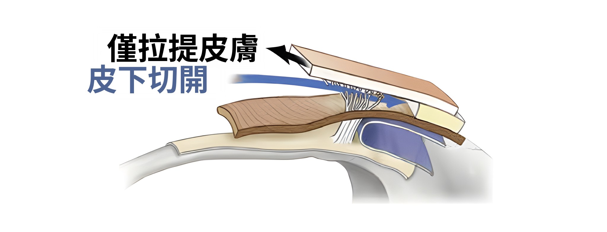 僅拉提皮膚時的剖面圖——箭頭標示「僅拉提皮膚」，藍色箭頭標示「皮下切開」