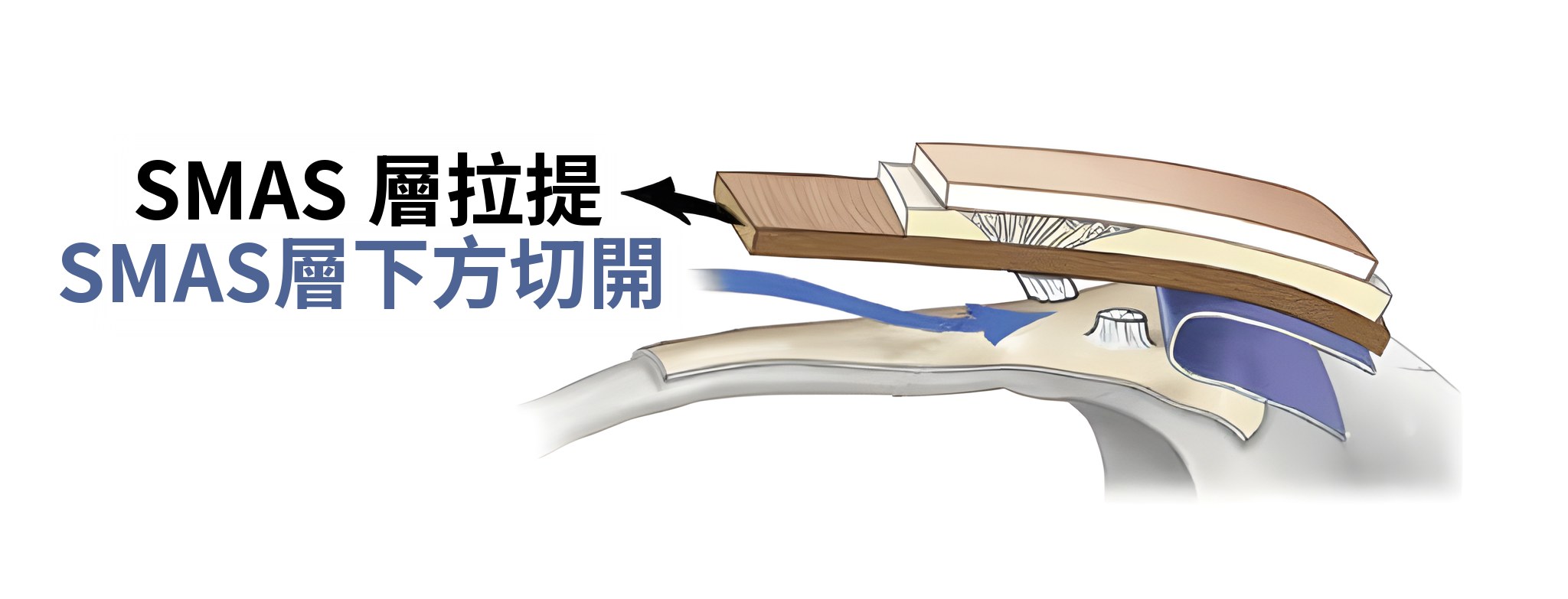拉提至SMAS層時的剖面圖——箭頭標示「SMAS層拉提」，藍色箭頭標示「SMAS層下方切開」