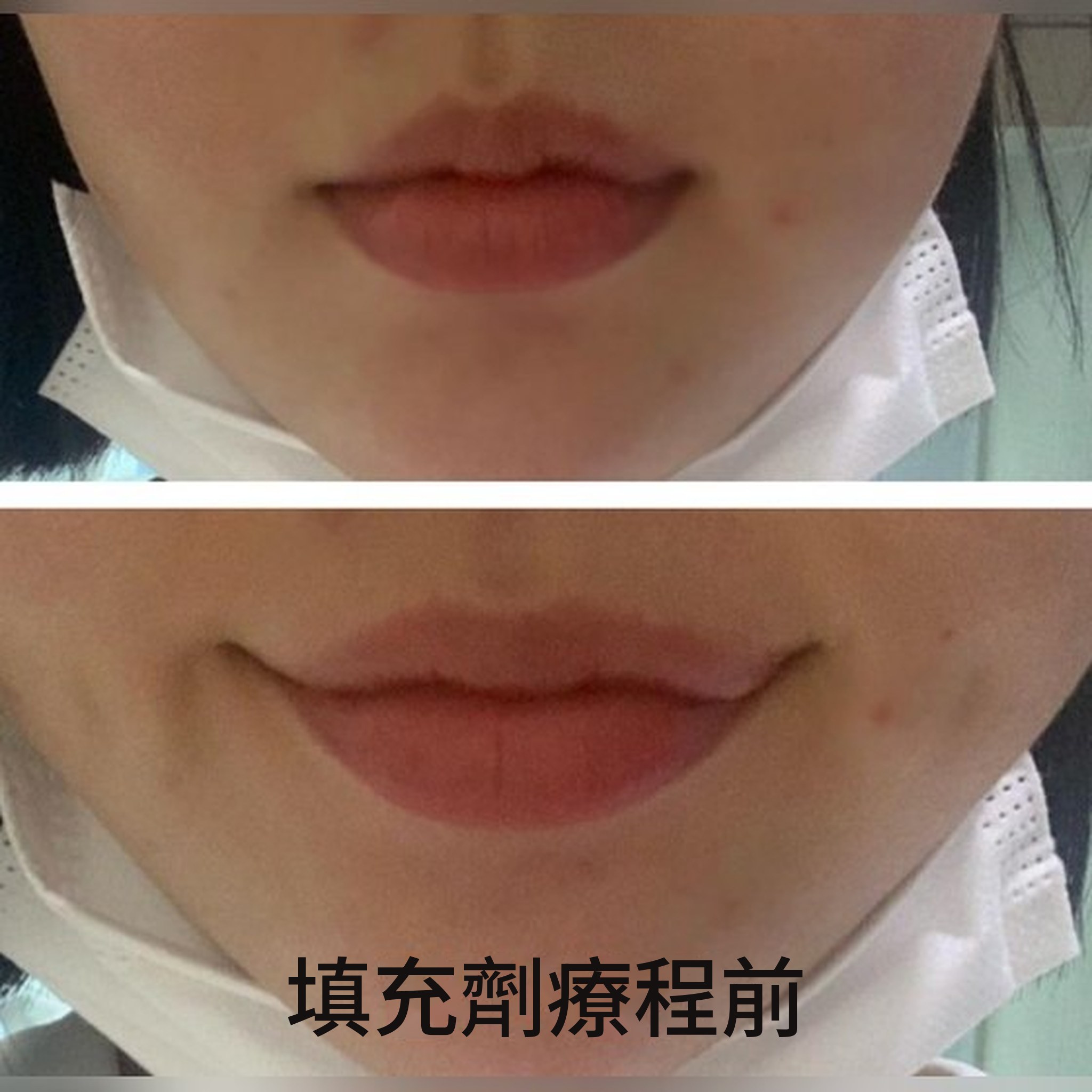 微整形心得文章縮圖 — 終於明白唇部填充為什麼這麼有名了