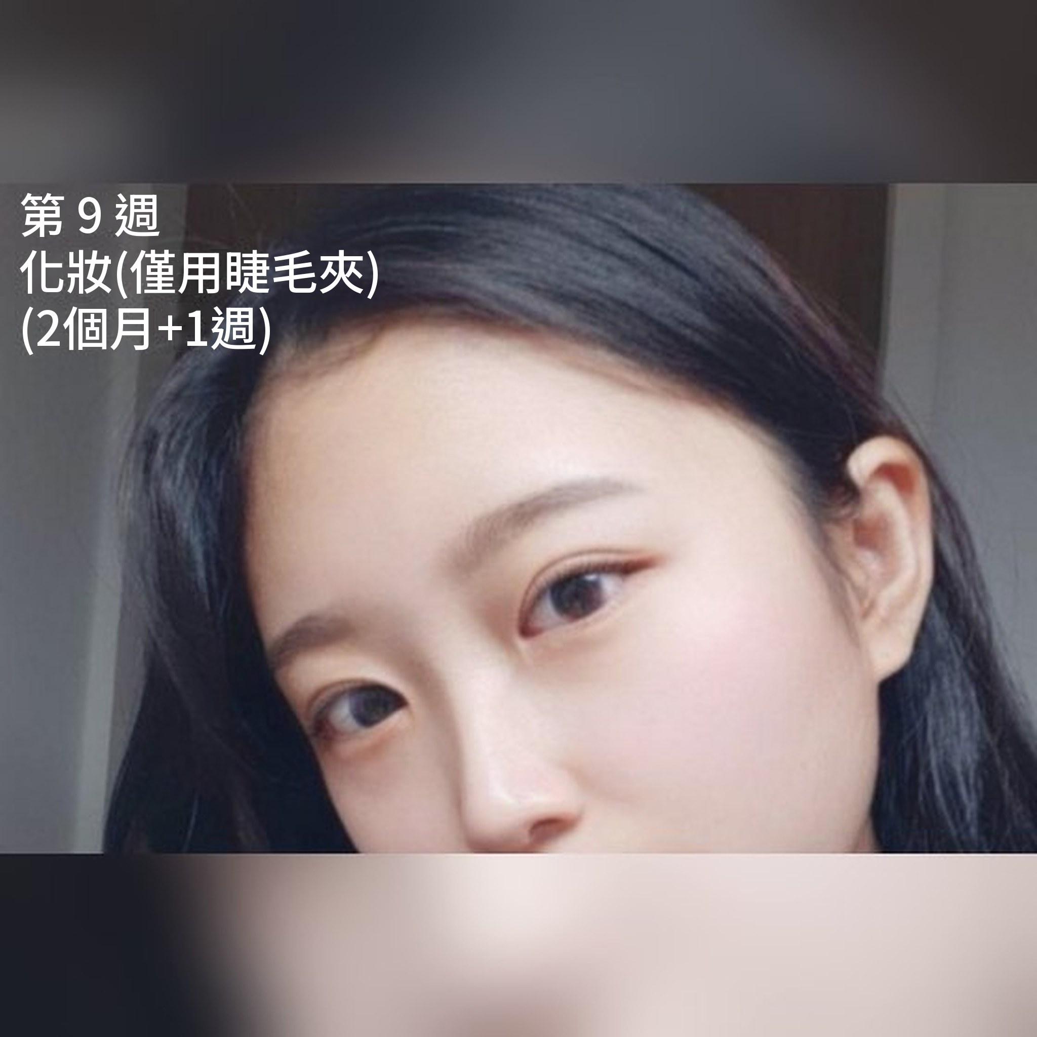 眼部整形心得文章縮圖 — 內開型雙眼皮/開眼頭/眼型矯正心得
