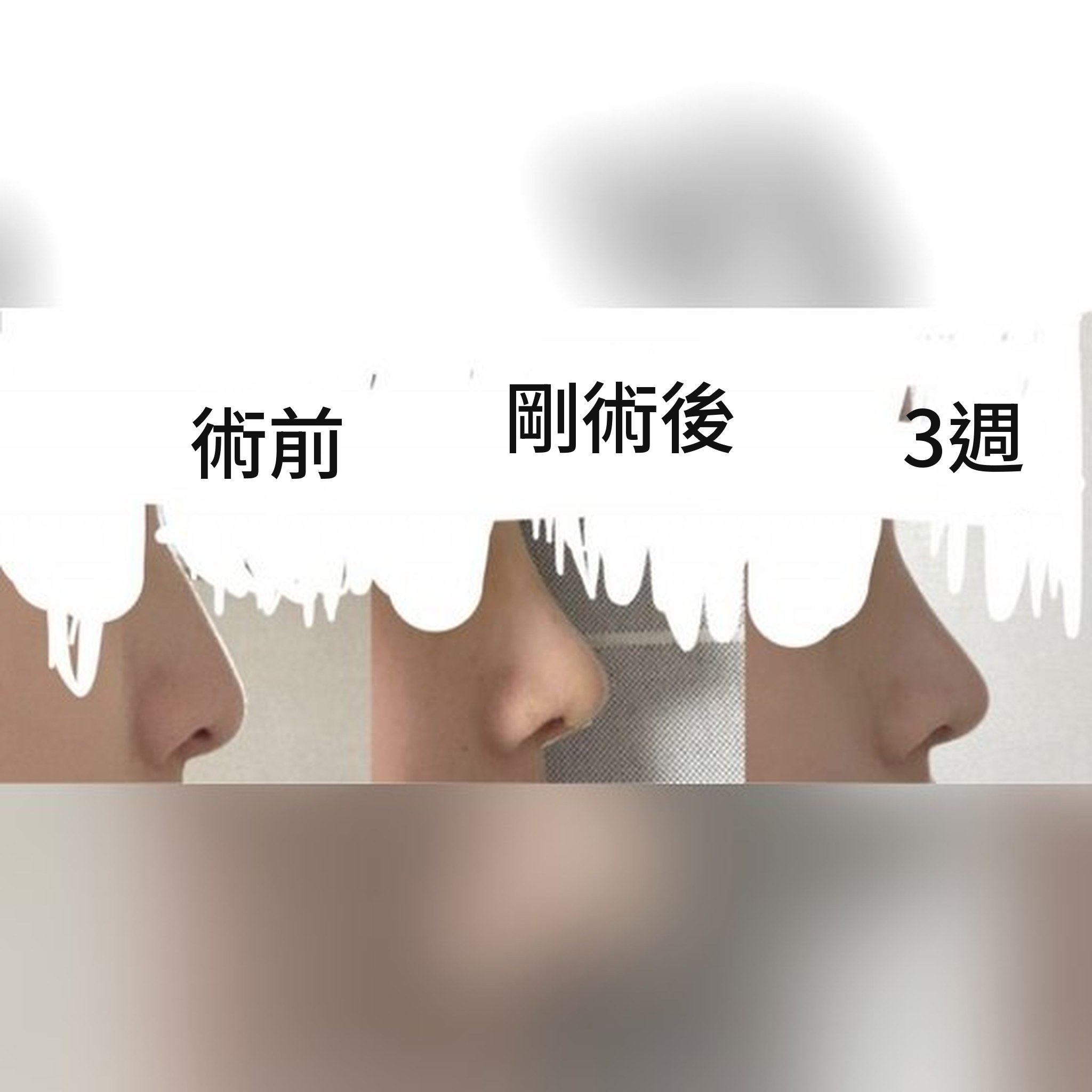 鼻整形心得文章縮圖 — 推薦Jegal Jeong⁠-⁠jae 院長的鼻整形！！！^-^