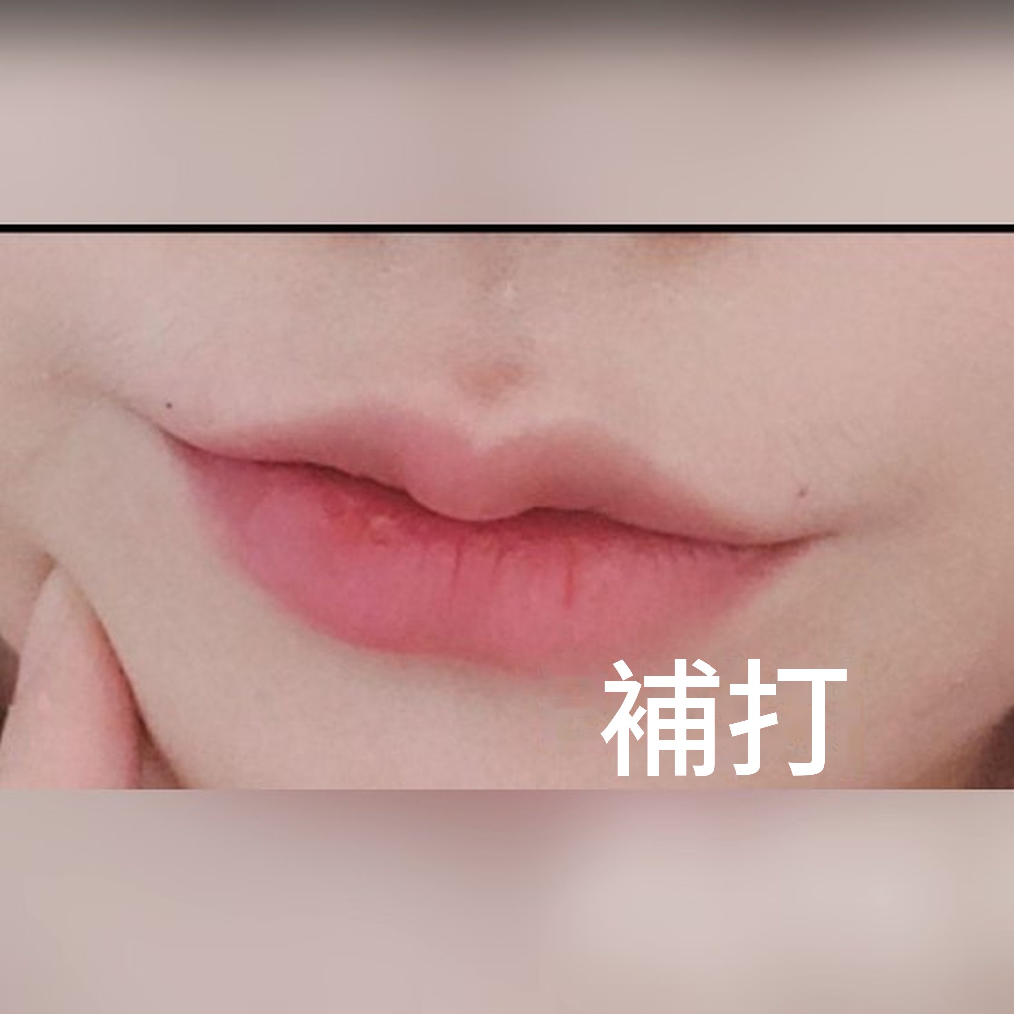微整形心得文章縮圖 — 唇部填充的名店沒錯!!哈哈