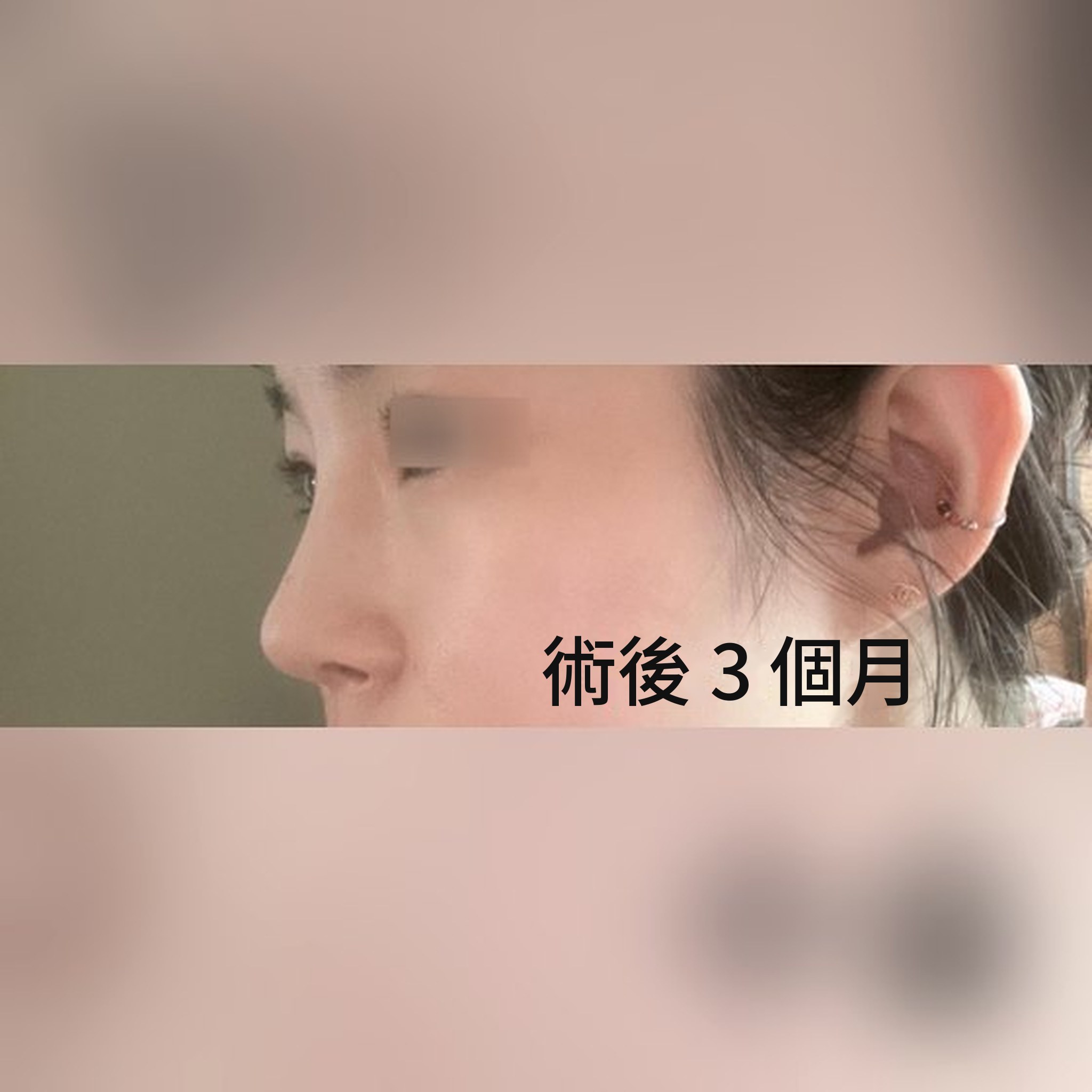 鼻整形心得文章縮圖 — 超滿意的鼻整形,已經第3個月了 哈哈