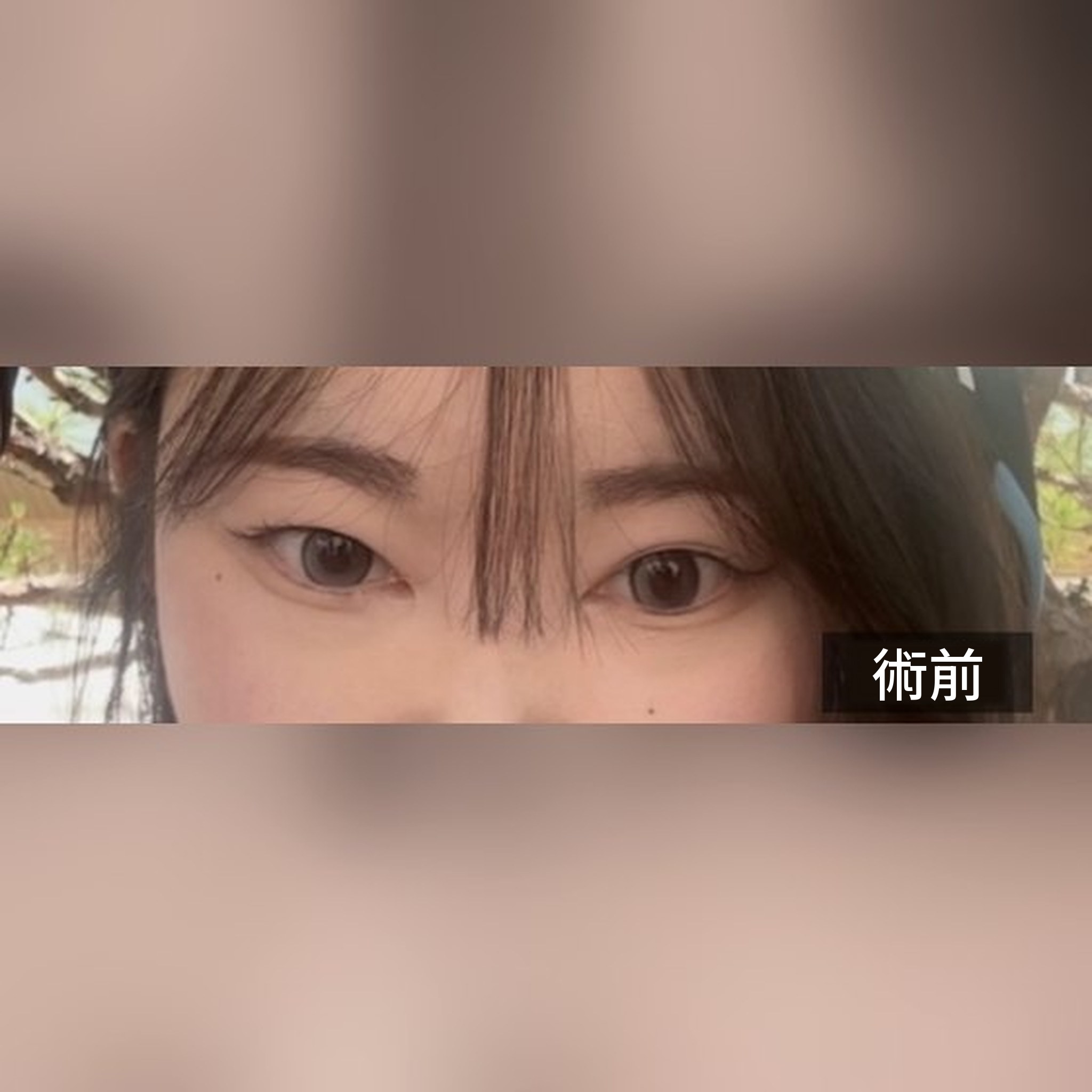 眼部整形心得文章縮圖 — 雙眼皮線條看起來對稱得很好~