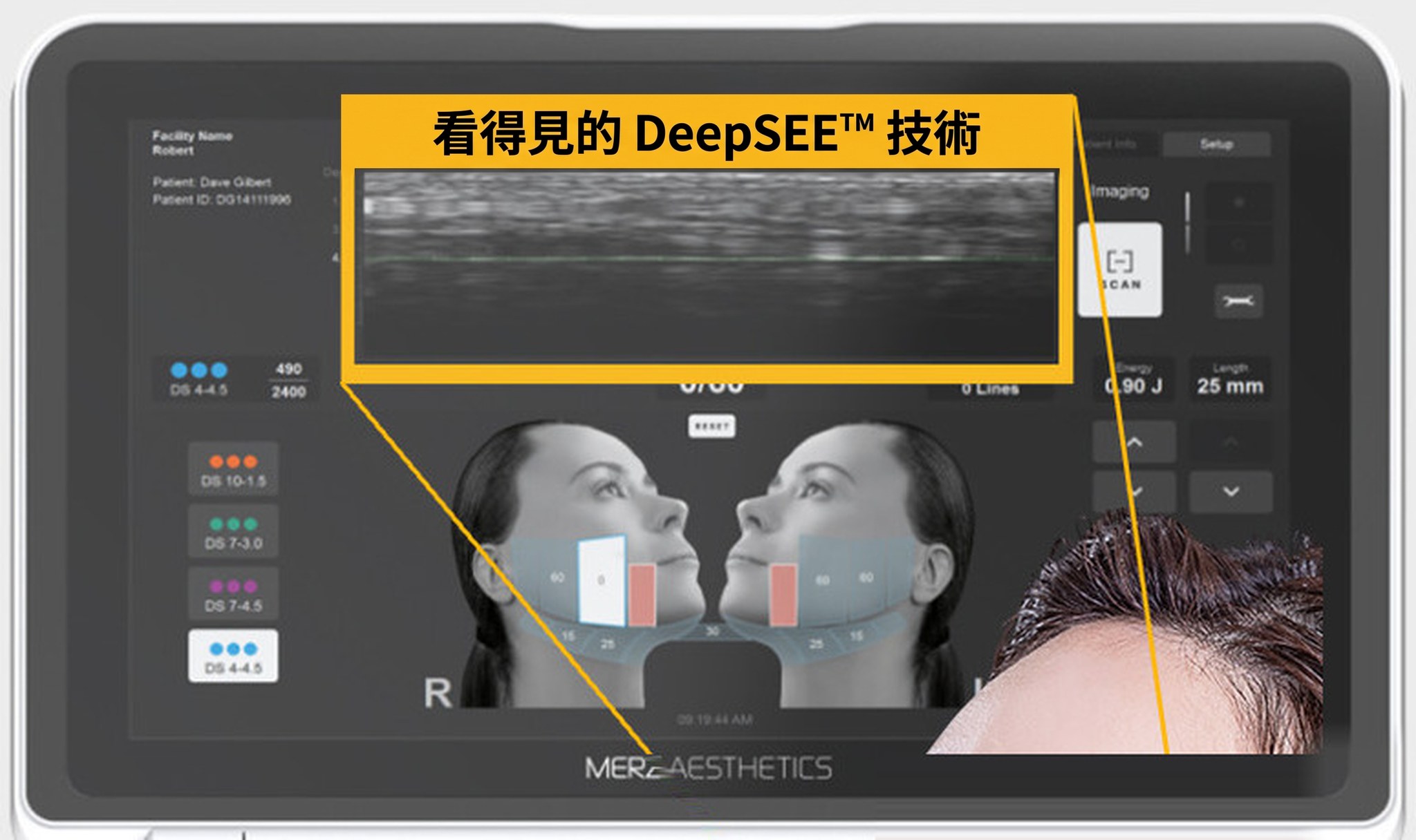 Ultherapy PRIME 螢幕——可見四邊邊框的設備畫面