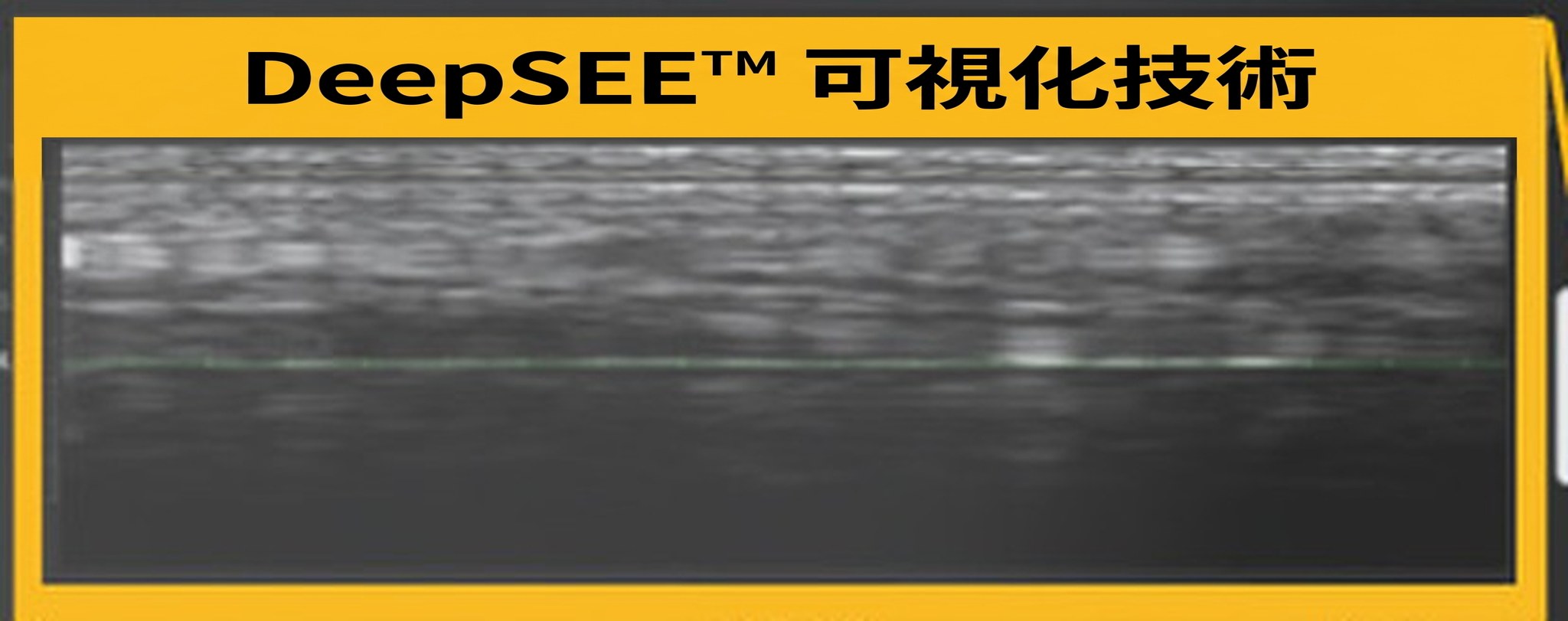 Ultherapy PRIME 螢幕上的 DeepSEE 標註——即時呈現的皮膚內部超音波剖面