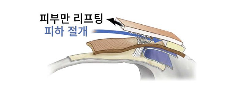 피부만 리프팅 했을 때의 단면 도해 — 화살표에 ‘피부만 리프팅’, 파란 화살표에 ‘피하 절개’ 라고 표시되어 있다