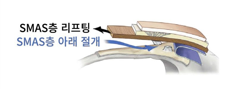 스마스층까지 리프팅 했을 때의 단면 도해 — 화살표에 ‘SMAS층 리프팅’, 파란 화살표에 ‘SMAS층 아래 절개’ 라고 표시되어 있다