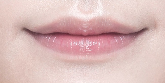 Front-view lip diagram with three injection points marked on the upper lip