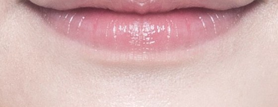 Lip diagram with the mouth corner injection points enlarged