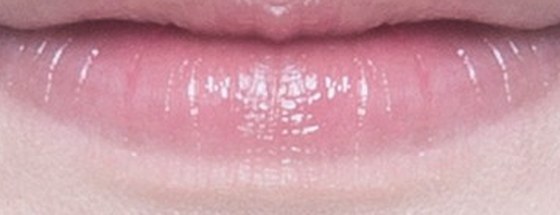 Lip diagram with the lower lip injection points enlarged
