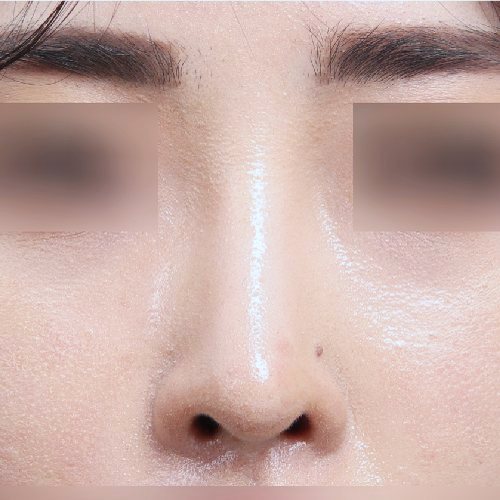 코성형 수술 후 정면