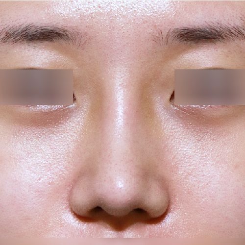 코성형 수술 후 정면