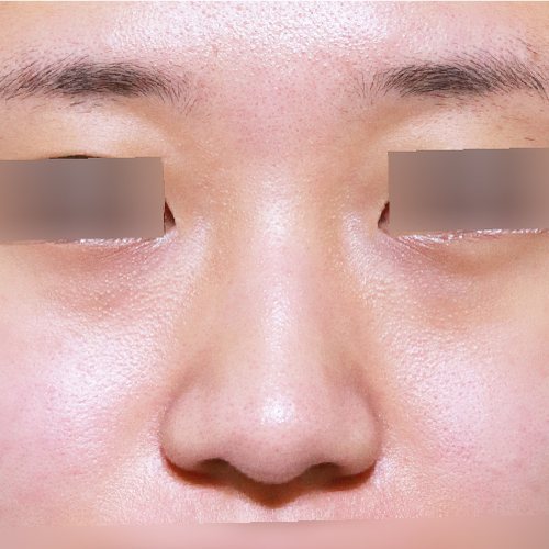 코성형 수술 전 정면