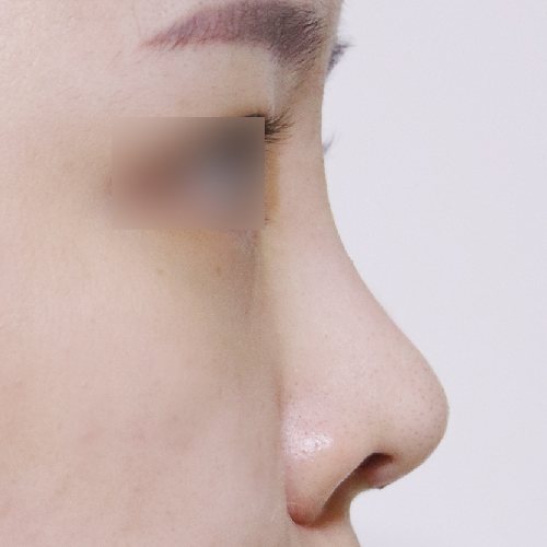 코성형 수술 후 옆모습