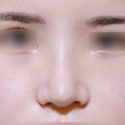 코성형 수술 후 정면