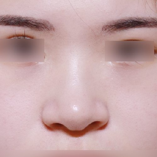 코성형 수술 전 정면