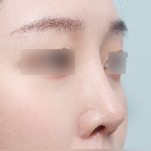코성형 수술 후 45도 옆모습