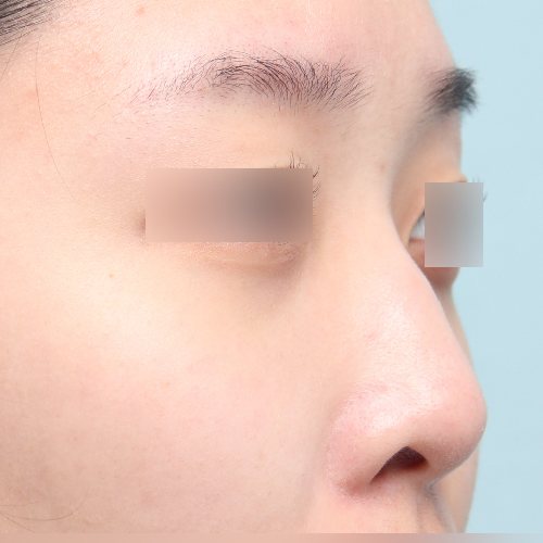 코성형 수술 전 45도 옆모습