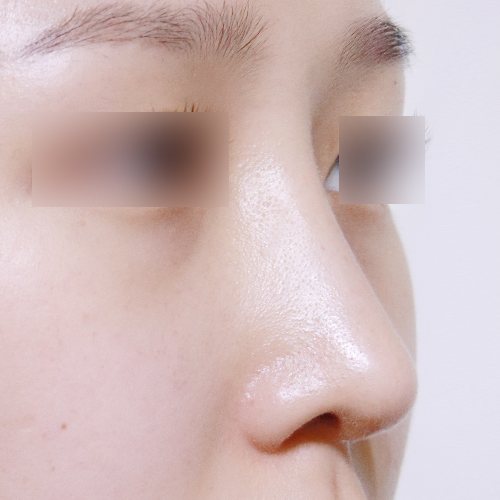 코성형 수술 후 45도 옆모습