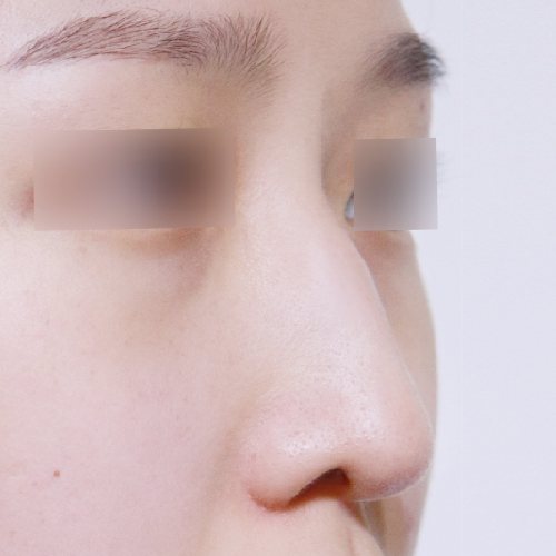 코성형 수술 전 45도 옆모습