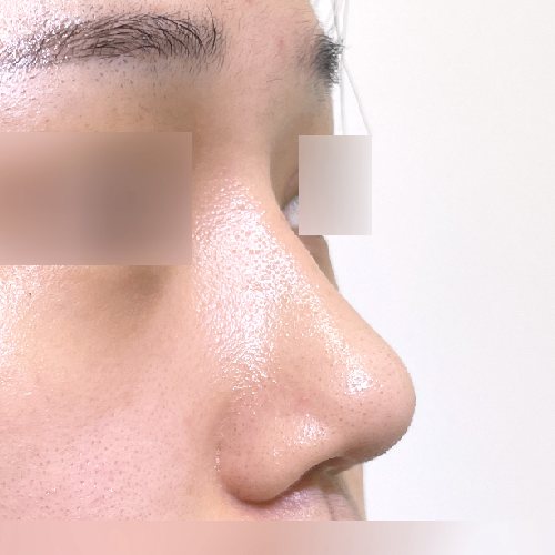 코성형 수술 후 옆모습