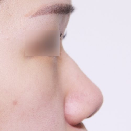 코성형 수술 전 옆모습
