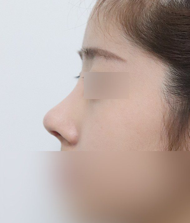 코재수술 후 옆모습